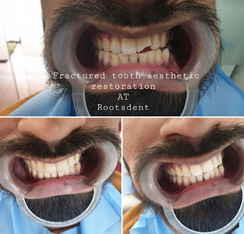 Best Dentist for Dentures in Kandivali