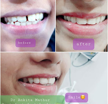 Best Dentist for Dentures in Kandivali