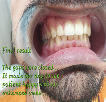 Best Dentist for Dentures in Kandivali